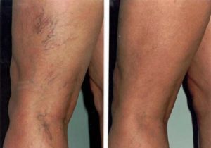 leg_spider_veins_edit