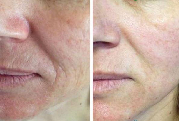 Ultraskin lifting policzków
