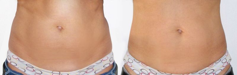 Ultraskin usuwanie nadmiaru tkanki tłuszczowej z brzucha
